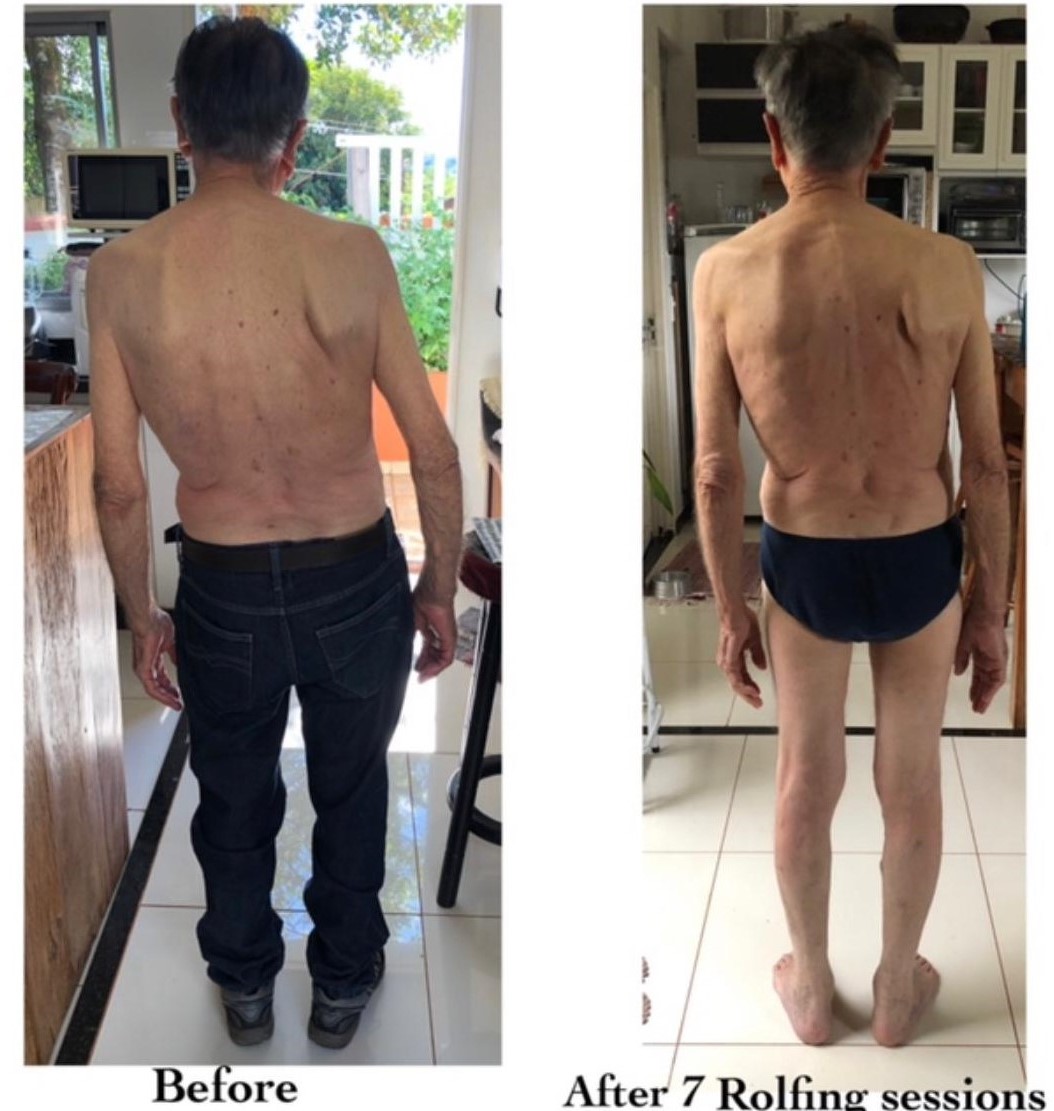 A client&rsquo;s posture seen from behind, before and after a series of seven Rolfing sessions with Joyce.
