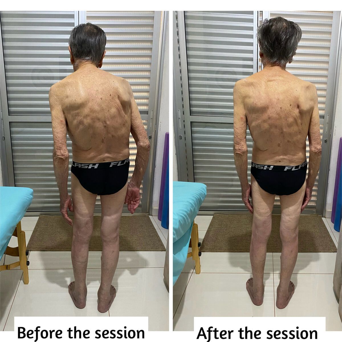 A client&rsquo;s posture seen from behind, before and after a single Rolfing session with Joyce.