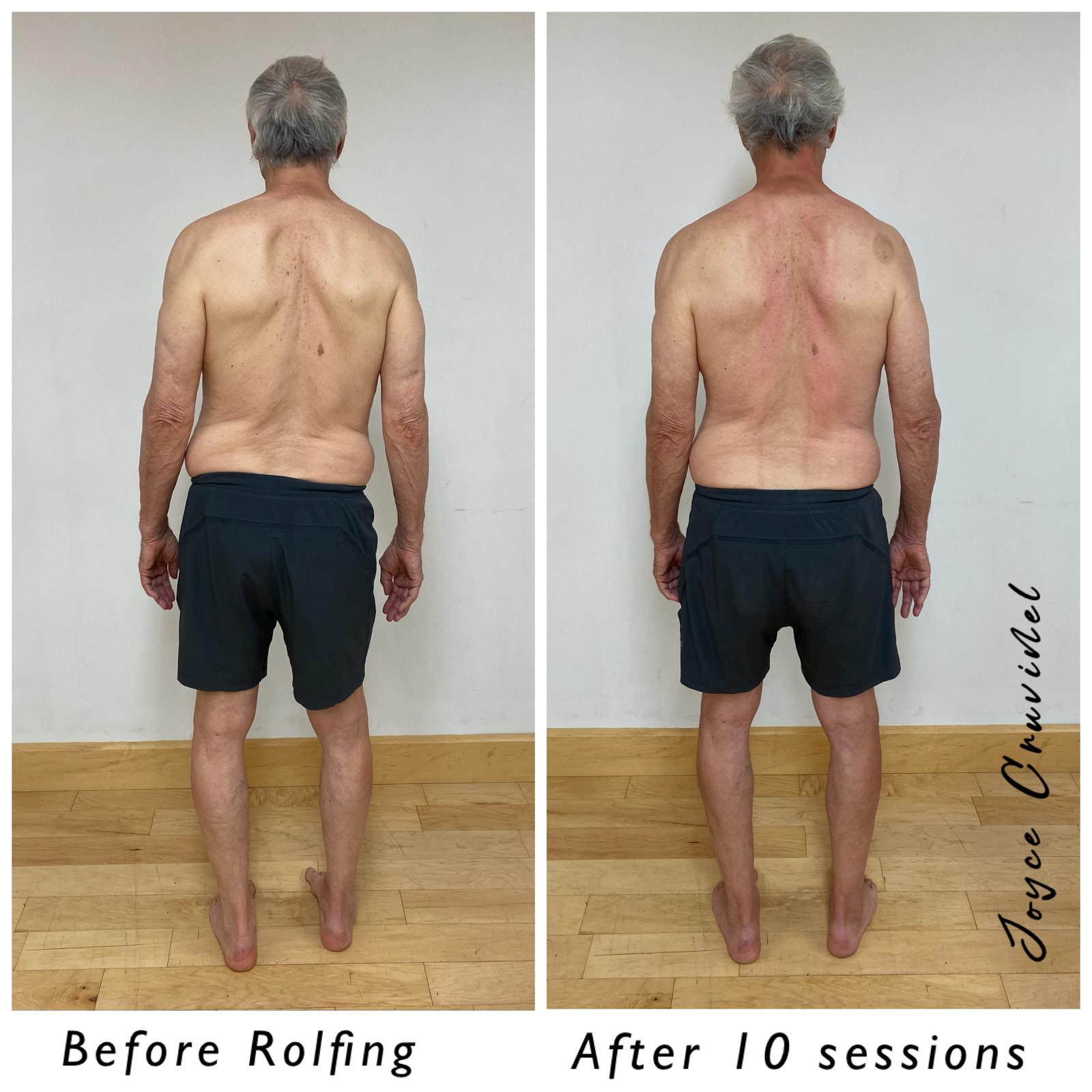 Michael B.&rsquo;s posture seen from behind, before Rolfing and after his series of ten sessions with Joyce.